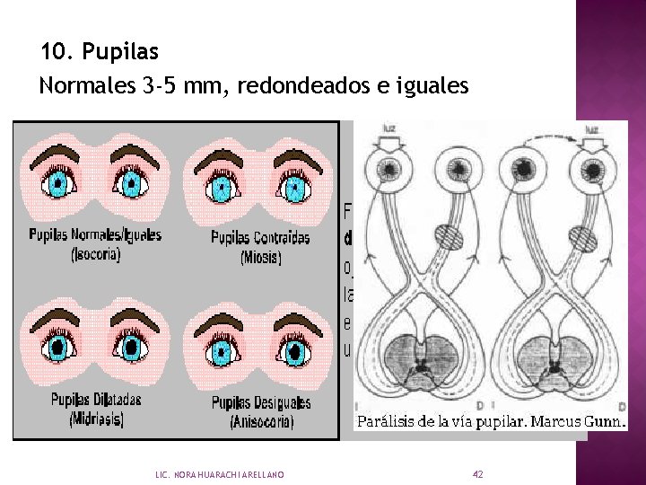 10. Pupilas Normales 3 -5 mm, redondeados e iguales LIC. NORA HUARACHI ARELLANO 42