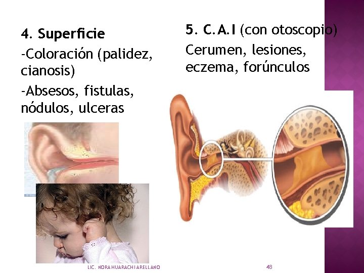 4. Superficie -Coloración (palidez, cianosis) -Absesos, fistulas, nódulos, ulceras LIC. NORA HUARACHI ARELLANO 5.