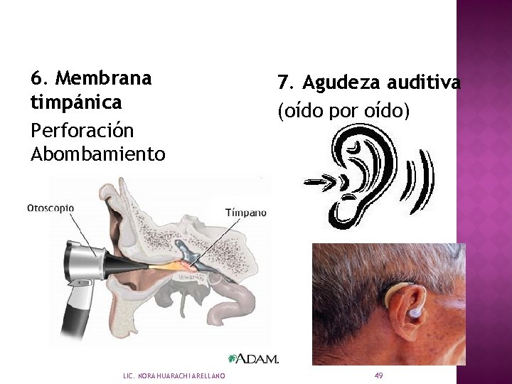 6. Membrana timpánica Perforación Abombamiento Retracción LIC. NORA HUARACHI ARELLANO 7. Agudeza auditiva (oído