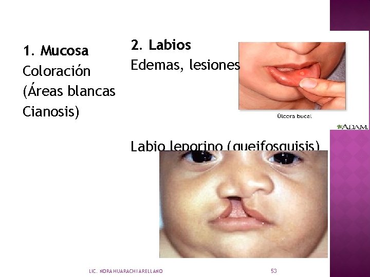 1. Mucosa Coloración (Áreas blancas Cianosis) 2. Labios Edemas, lesiones Labio leporino (queifosquisis) LIC.