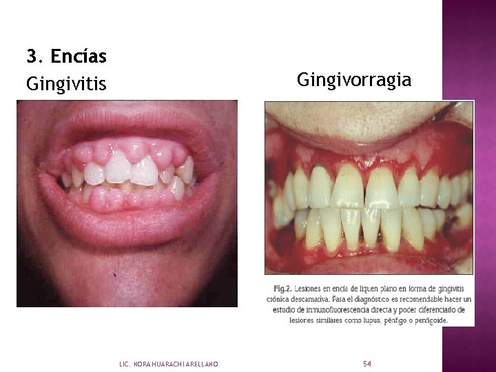 3. Encías Gingivitis Gingivorragia LIC. NORA HUARACHI ARELLANO 54 