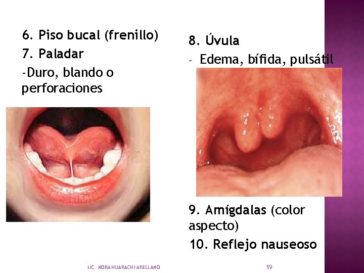 6. Piso bucal (frenillo) 7. Paladar -Duro, blando o perforaciones 8. Úvula - Edema,