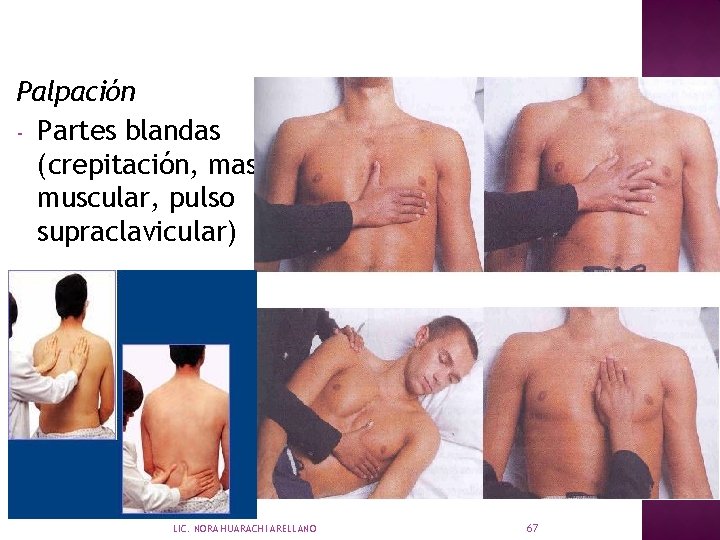 Palpación - Partes blandas (crepitación, masa muscular, pulso supraclavicular) LIC. NORA HUARACHI ARELLANO 67