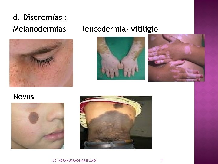 d. Discromías : Melanodermias leucodermia- vitiligio Nevus LIC. NORA HUARACHI ARELLANO 7 