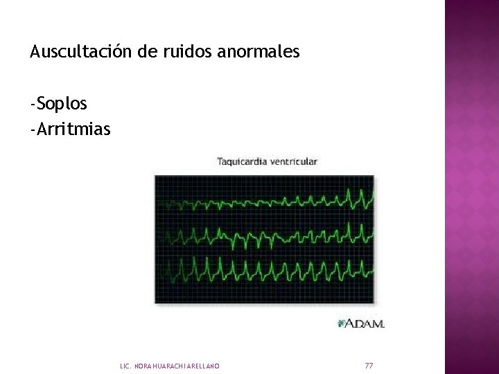 Auscultación de ruidos anormales -Soplos -Arritmias LIC. NORA HUARACHI ARELLANO 77 