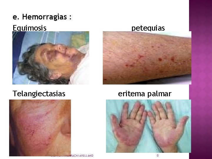 e. Hemorragias : Equimosis Telangiectasias LIC. NORA HUARACHI ARELLANO petequias eritema palmar 8 