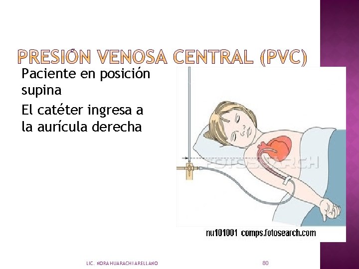 Paciente en posición supina El catéter ingresa a la aurícula derecha LIC. NORA HUARACHI