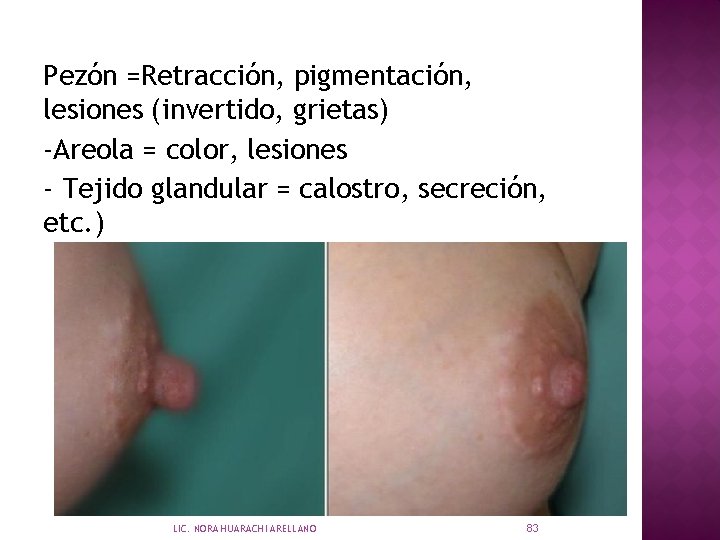 Pezón =Retracción, pigmentación, lesiones (invertido, grietas) -Areola = color, lesiones - Tejido glandular =