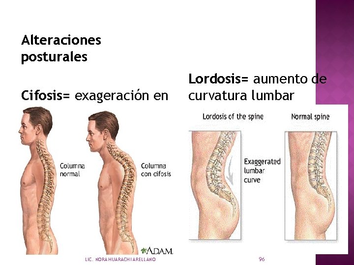 Alteraciones posturales Cifosis= exageración en curvatura en tórax LIC. NORA HUARACHI ARELLANO Lordosis= aumento