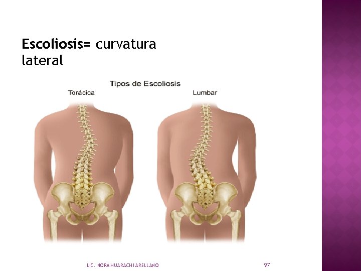 Escoliosis= curvatura lateral LIC. NORA HUARACHI ARELLANO 97 