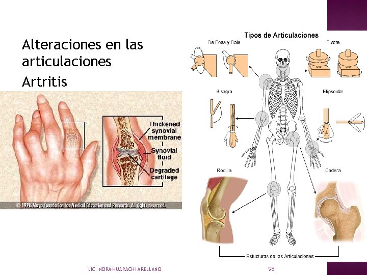 Alteraciones en las articulaciones Artritis LIC. NORA HUARACHI ARELLANO 98 