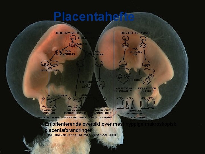 Placentahefte En orienterende oversikt over mest hyppige makroskopisk placentaforandringer Gitta Turowski, Anne Lid Øvre,