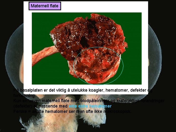 Maternell flate På basalplaten er det viktig å utelukke koagler, hematomer, defekter og forkalkning.