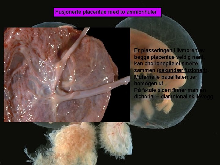 Fusjonerte placentae med to amnionhuler Er plasseringen i livmoren av begge placentae veldig nært,
