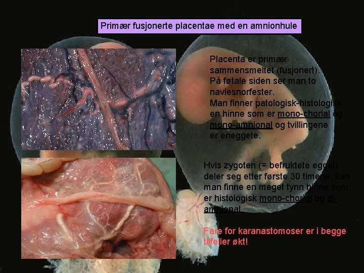 Primær fusjonerte placentae med en amnionhule Placenta er primær sammensmeltet (fusjonert). På føtale siden