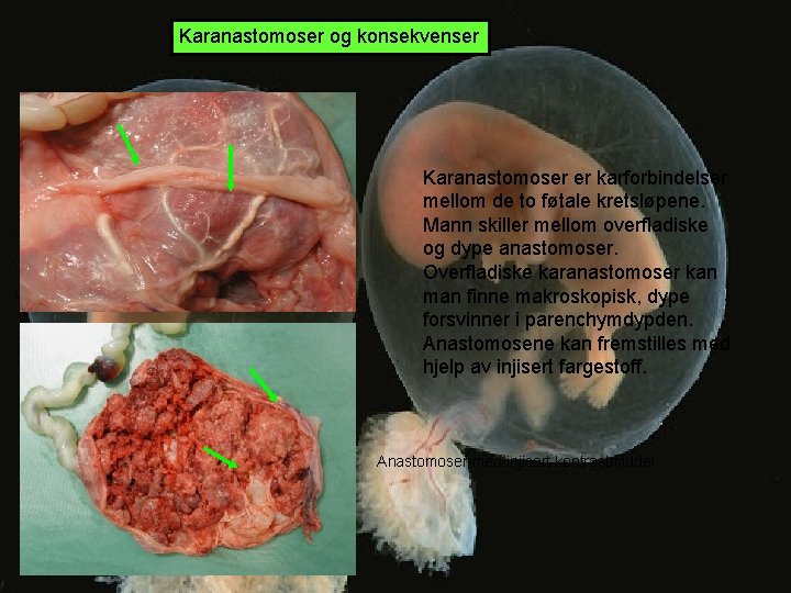 Karanastomoser og konsekvenser Karanastomoser er karforbindelser mellom de to føtale kretsløpene. Mann skiller mellom