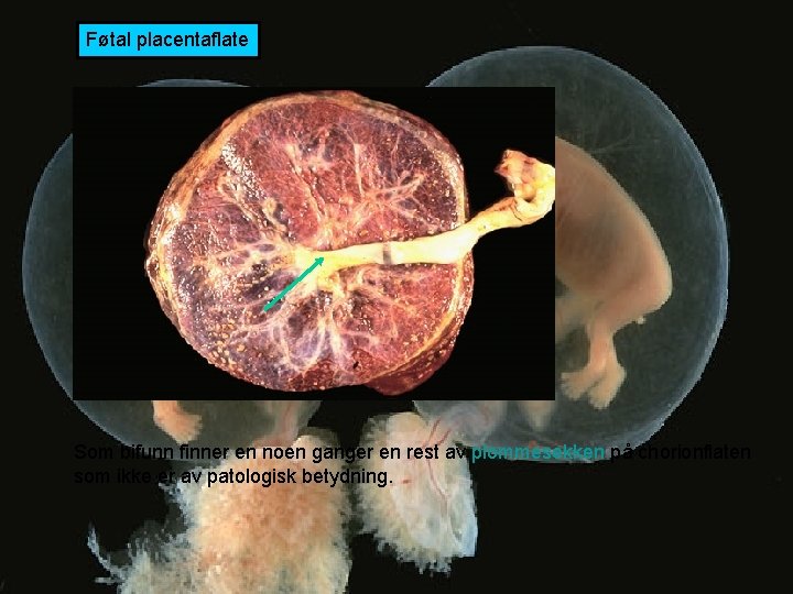 Føtal placentaflate Som bifunn finner en noen ganger en rest av plommesekken på chorionflaten