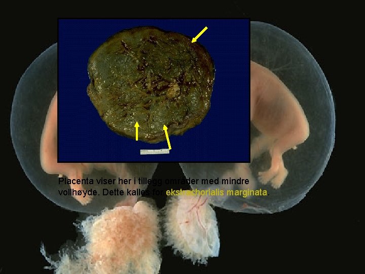 Placenta viser her i tillegg områder med mindre vollhøyde. Dette kalles for ekstrachorialis marginata.