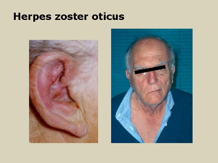 Herpes zoster oticus 