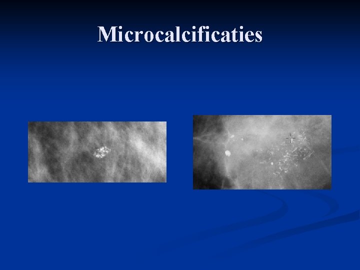 Microcalcificaties 