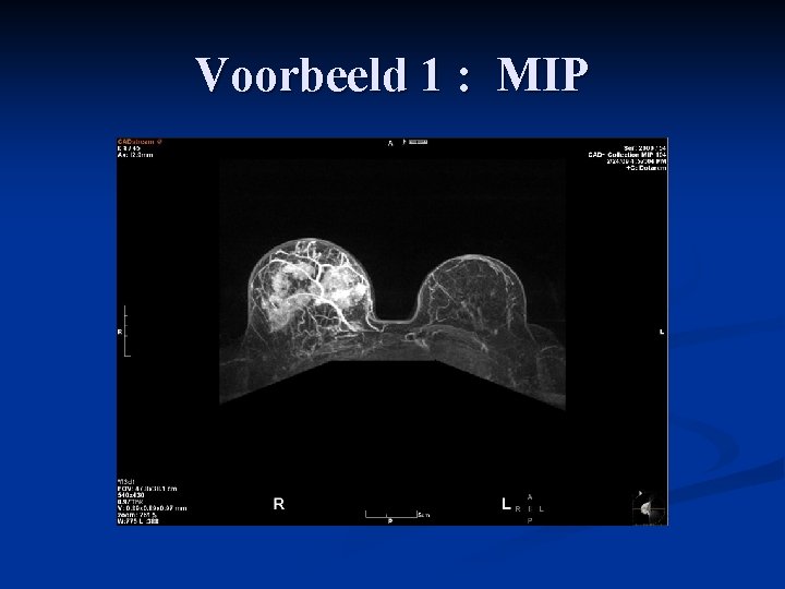 Voorbeeld 1 : MIP 