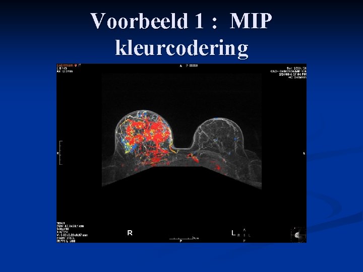 Voorbeeld 1 : MIP kleurcodering 