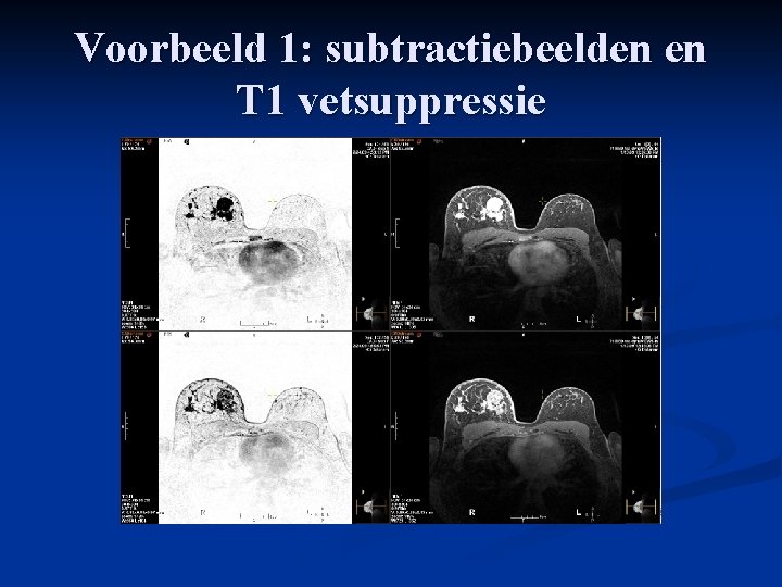 Voorbeeld 1: subtractiebeelden en T 1 vetsuppressie 