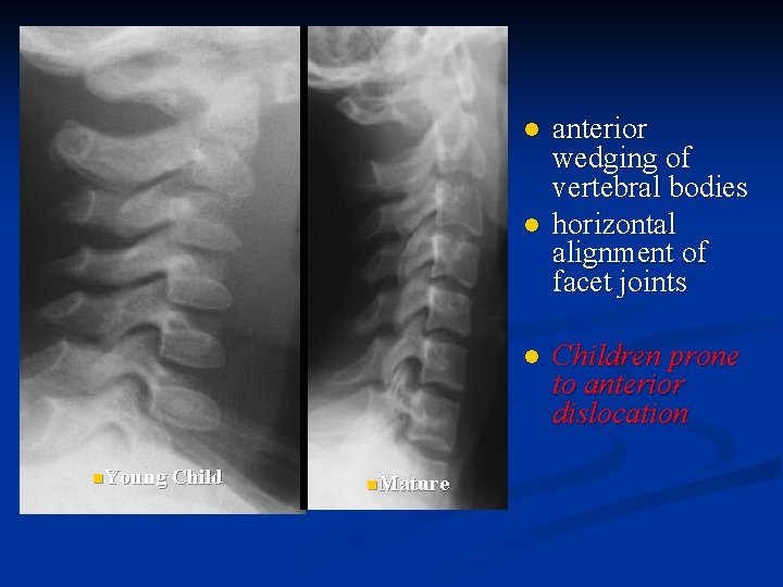 l l l n. Young Child n. Mature anterior wedging of vertebral bodies horizontal