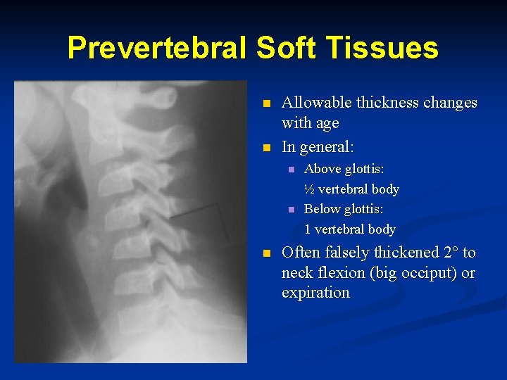 Prevertebral Soft Tissues n n Allowable thickness changes with age In general: n n