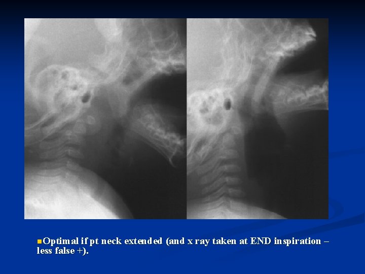 n. Optimal if pt neck extended (and x ray taken at END inspiration –