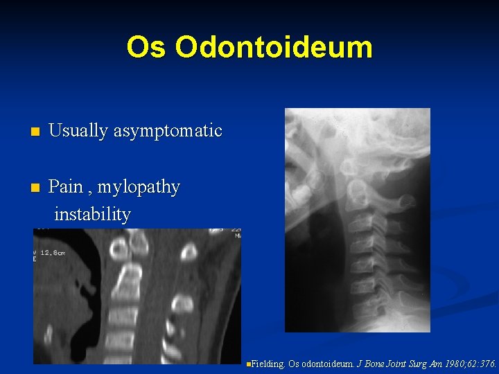 Os Odontoideum n Usually asymptomatic n Pain , mylopathy instability n. Fielding. Os odontoideum.
