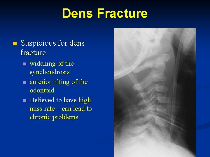 Dens Fracture n Suspicious for dens fracture: n n n widening of the synchondrosis