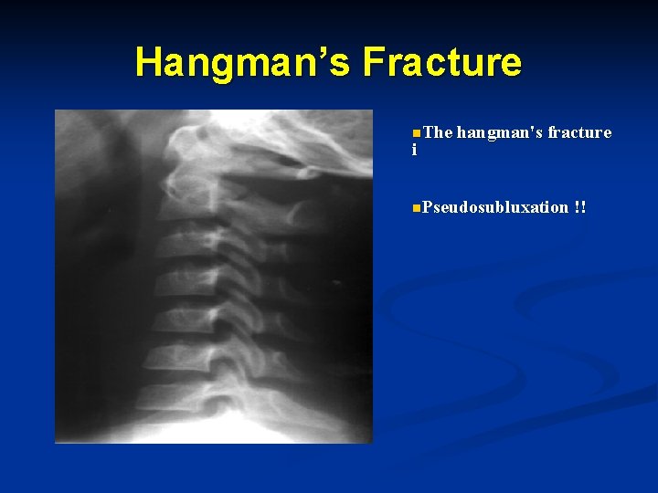 Hangman’s Fracture n. The hangman's fracture i n. Pseudosubluxation !! 