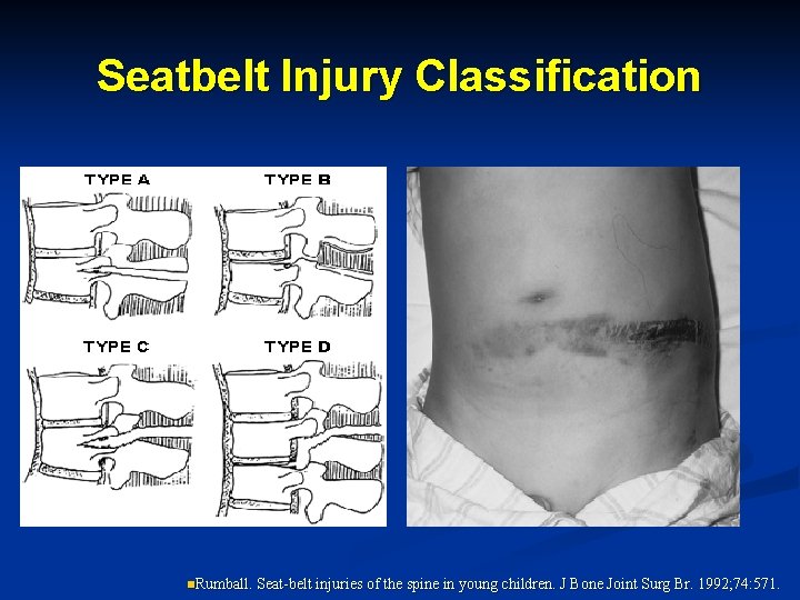 Seatbelt Injury Classification n. Rumball. Seat-belt injuries of the spine in young children. J