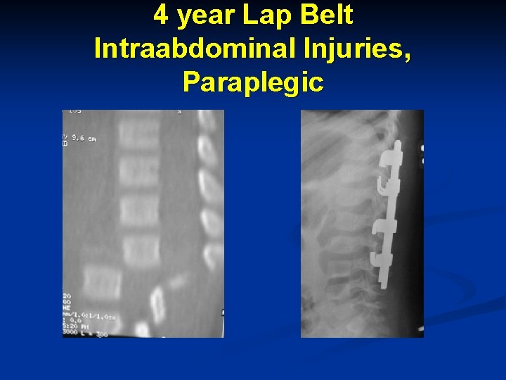 4 year Lap Belt Intraabdominal Injuries, Paraplegic 