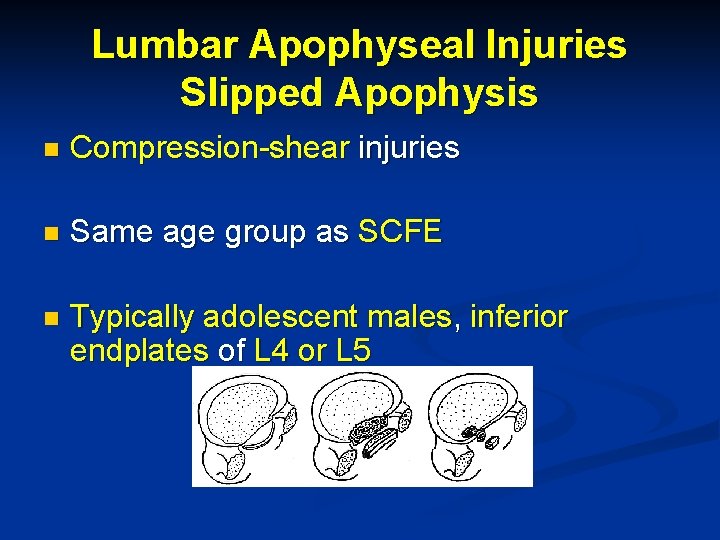 Lumbar Apophyseal Injuries Slipped Apophysis n Compression-shear injuries n Same age group as SCFE