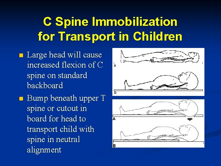 C Spine Immobilization for Transport in Children n n Large head will cause increased