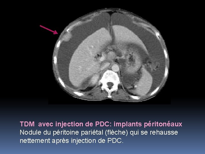 TDM avec injection de PDC: implants péritonéaux Nodule du péritoine pariétal (flèche) qui se