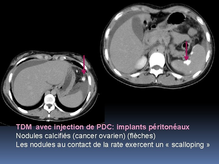 TDM avec injection de PDC: implants péritonéaux Nodules calcifiés (cancer ovarien) (flèches) Les nodules