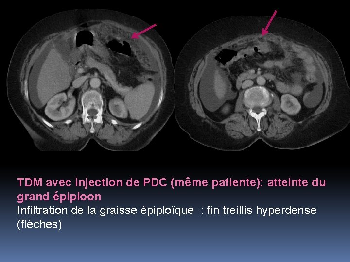 TDM avec injection de PDC (même patiente): atteinte du grand épiploon Infiltration de la