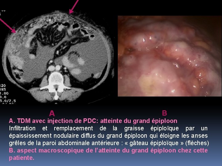 A B A. TDM avec injection de PDC: atteinte du grand épiploon Infiltration et