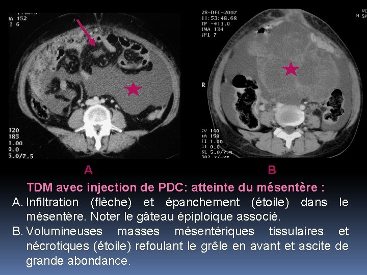 A B TDM avec injection de PDC: atteinte du mésentère : A. Infiltration (flèche)