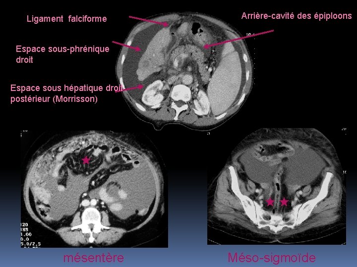 Ligament falciforme Arrière-cavité des épiploons Espace sous-phrénique droit Espace sous hépatique droit postérieur (Morrisson)