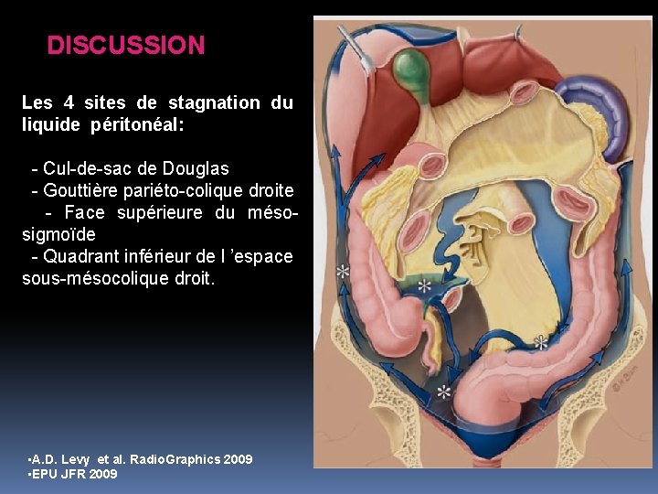 DISCUSSION Les 4 sites de stagnation du liquide péritonéal: - Cul-de-sac de Douglas - DISCUSSION Les 4 sites de stagnation du liquide péritonéal: - Cul-de-sac de Douglas -