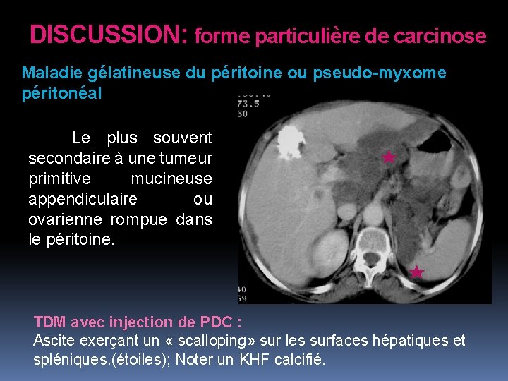 DISCUSSION: forme particulière de carcinose Maladie gélatineuse du péritoine ou pseudo-myxome péritonéal Le plus DISCUSSION: forme particulière de carcinose Maladie gélatineuse du péritoine ou pseudo-myxome péritonéal Le plus