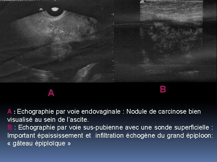 A B A : Echographie par voie endovaginale : Nodule de carcinose bien visualisé