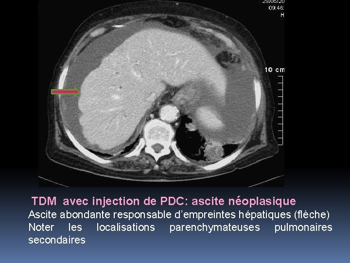 TDM avec injection de PDC: ascite néoplasique Ascite abondante responsable d’empreintes hépatiques (flèche) Noter