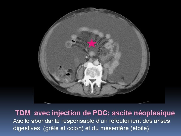 TDM avec injection de PDC: ascite néoplasique Ascite abondante responsable d’un refoulement des anses