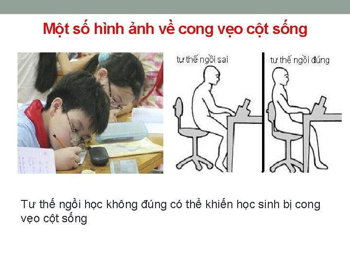 Một số hình ảnh về cong vẹo cột sống Tư thế ngồi học không