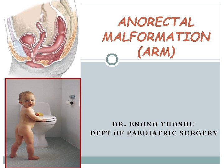 ANORECTAL MALFORMATION (ARM) DR. ENONO YHOSHU DEPT OF PAEDIATRIC SURGERY ANORECTAL MALFORMATION (ARM) DR. ENONO YHOSHU DEPT OF PAEDIATRIC SURGERY